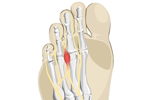 What is Morton's Neuroma?