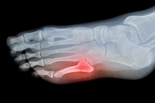 Causes, Symptoms, and Treatment for a Broken Foot