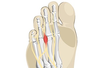 Definition and Risk Factors of Morton’s Neuroma