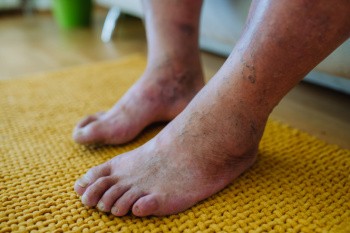 How Diabetes Affects the Feet